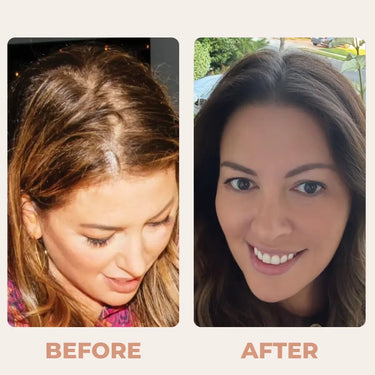 Hair Thinning