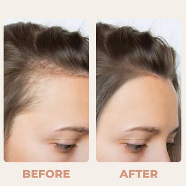 Receding Hairline