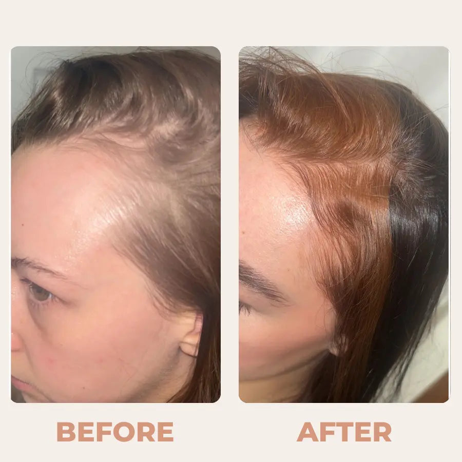 Athena™ Complete Hair Revival Bundle